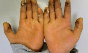 8歲小學(xué)生沉迷拍煙卡手指潰爛縮略圖 8歲小學(xué)生沉迷拍煙卡手指潰爛縮略圖