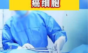 男子確診肺癌醫生一根針凍死癌細胞縮略圖